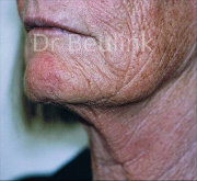 laser resurfacing skin rejuvenation before (180)
